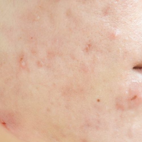 cicatriz-de-acne-no-rosto_46178-176